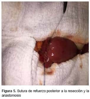 Sutura de refuerzo posterior a la Resección y la Anastomosis Sutura de refuerzo posterior a la Resección y la Anastomosis
