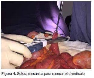 Sutura Mecánica para resecar el Divertículo Sutura Mecánica para resecar el Divertículo