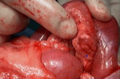 insulinoma-diagnostico-1.jpg