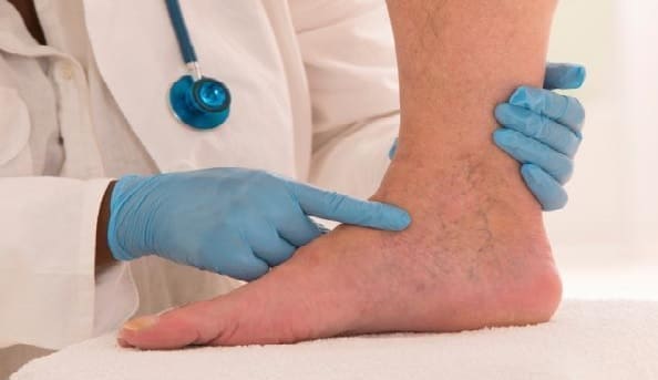 tratamiento-flebitis.jpg