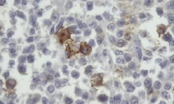 Linfoma Angiocéntrico de Nariz y Senos Paranasales, Diagnóstico