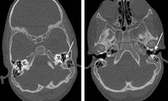 Rabdomiosarcoma Embrionario del Oído Medio